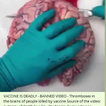 Vaccine-is-deadly-Rhromboses-in-brains-people-killed-by-vax